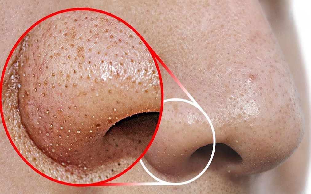 Tips to Get Rid of Blackheads