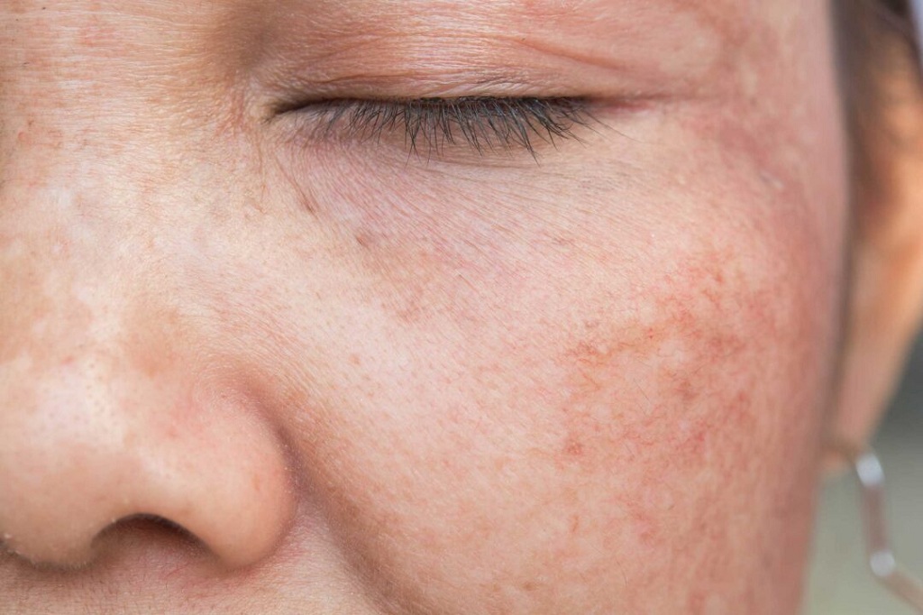 Problems Associated with Hyperpigmentation